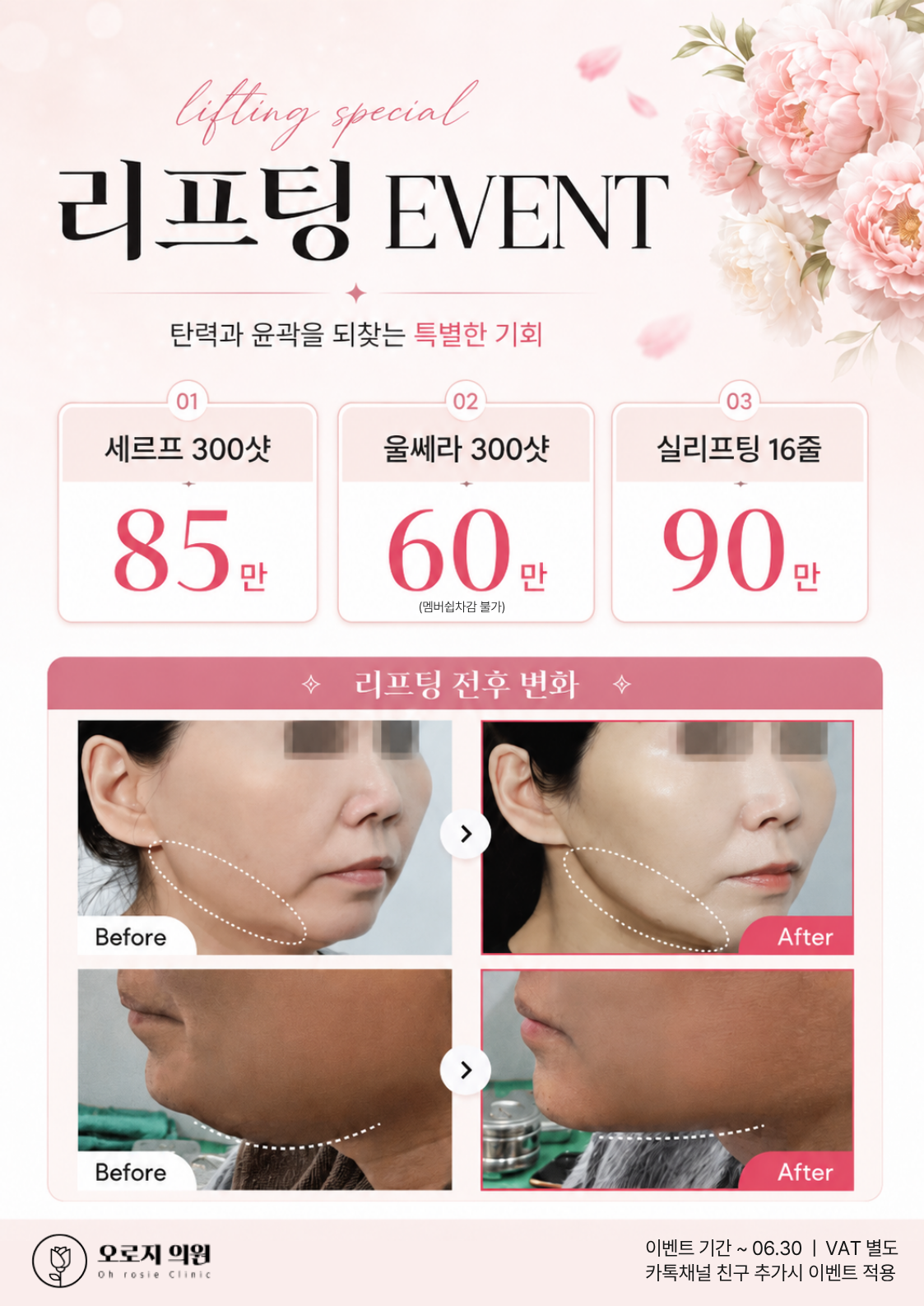 리프팅 이벤트